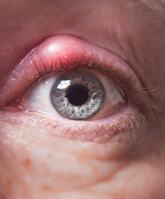 chalazion - soin ophtalmologue