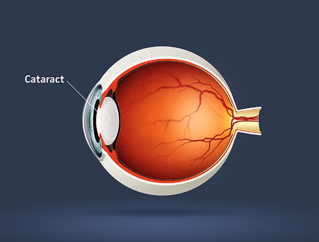 Chirurgie cataracte