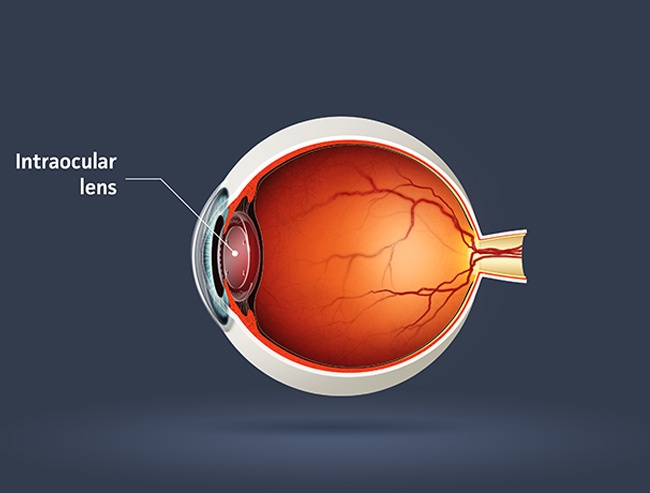 Chirurgie cataracte