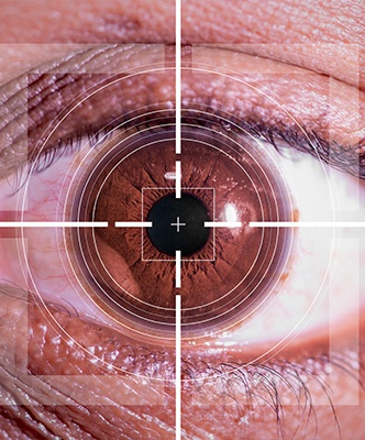 Lasik
